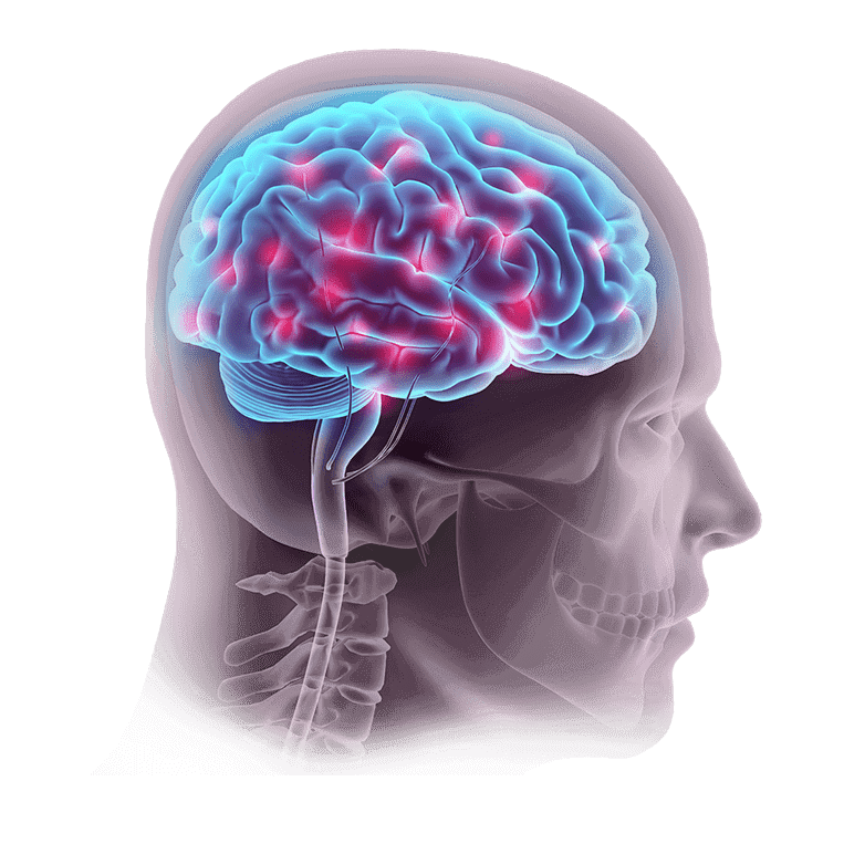 Ilustración del cerebro con dolor de cabeza fuerte en rayos X